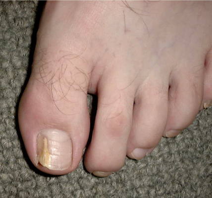 Things to Review Before Going for Onychomycosis Treatment