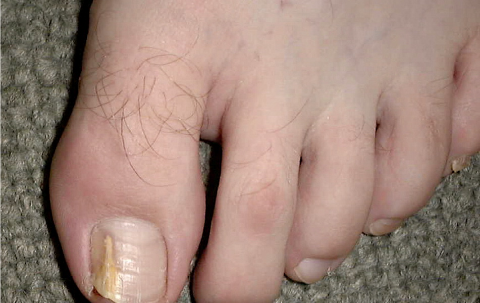 Things to Review Before Going for Onychomycosis Treatment